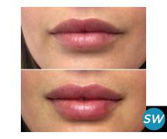 lip fillers in delhi - 1