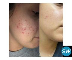 Acne Treatment in Delhi