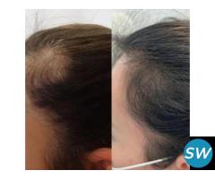 prp treatment for hair restoration in delhi