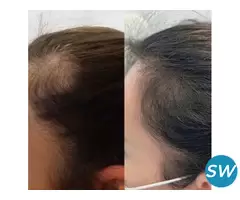 prp treatment for hair restoration in delhi