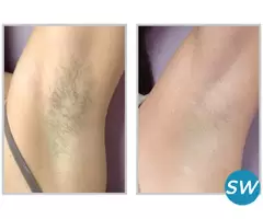 laser hair reduction in delhi