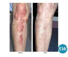 AROGYAM PURE HERBS KIT FOR PSORIASIS