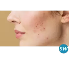 Acne scar Removal Treatment in Hyderabad