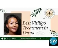 Best Vitiligo Treatment in Patna