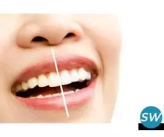 Teeth Whitening at Discounted Rates - 1