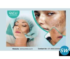 Hyperpigmentations Treatment in Bangalore