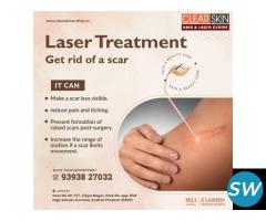 best Birthmark removal laser treatment in india