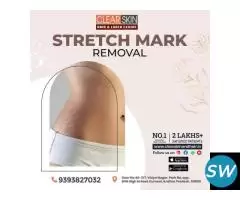 Hair Transplant Treatment in india