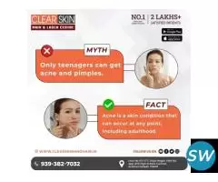 Birthmark removal treatment in india - 1