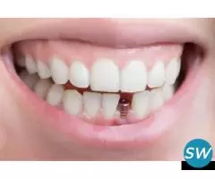 Single Tooth Dental Implants - 1
