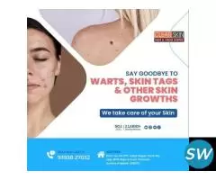 Best Birthmark removal laser treatment