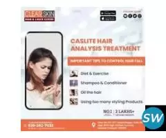 facial port wine stain Treatment in india