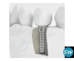 Dental Implants in Vasant Kunj