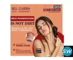 Stretch Marks  Laser  Treatment in India