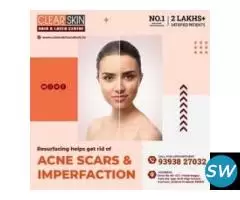 Birthmark removal treatment in india - 1