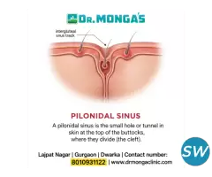 Pilonidal Sinus Treatment Without Surgery - 1
