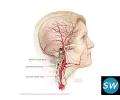 Advanced Carotid Artery Care