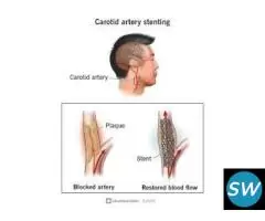 Advanced Carotid Artery Care