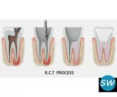 Advanced Root Canal Treatment in Noida