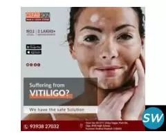 portwine stain treatment in india