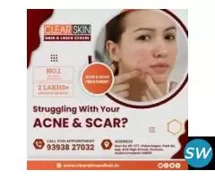 best vascular laser treatment in india