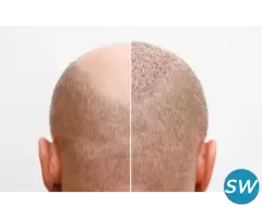 Best Hair Transplant Surgeon in Gurgaon