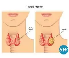 State-of-the-art thyroid nodule treatments