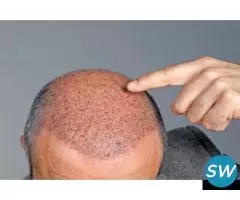 Best Hair Transplant Clinic in Gurgaon