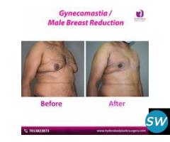 Best Gynecomastia Surgery in Hyderabad - 4
