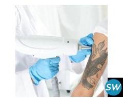 Tattoo Removal in Kharadi | Laser Tattoo Removal Treatment in Kharadi