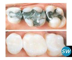 Tooth Fillings Treatment in Pimple Saudagar | Tooth Coloured Filling Services in Pimple Saudagar- Dr