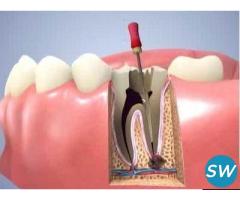 Root Canal Treatment in Pimple Saudagar