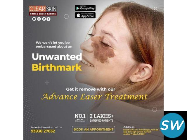 best Birthmark removal laser treatment in hyderabad - 1