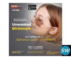 best Birthmark removal laser treatment in hyderabad