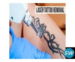 Tattoo removal treatment in Hyderabad