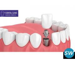 Dental implants cost
