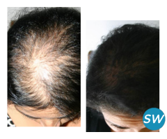 Hair Patch Replacement Center Bangalore - 1