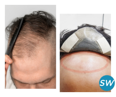 Hair Replacement in Bangalore