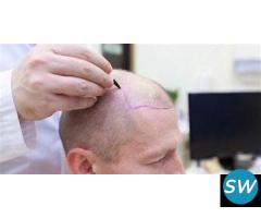 Hair transplant cost in Rajasthan - 1