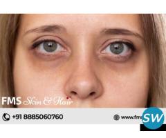 Dark circles removal treatment in Hyderabad - 1