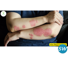 How to Cure Psoriasis Permanently