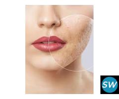 Top-Rated Acne Scars Treatment in Jaipur